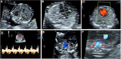 Four-section approach of fetal congenital heart disease at 11–13+6 weeks